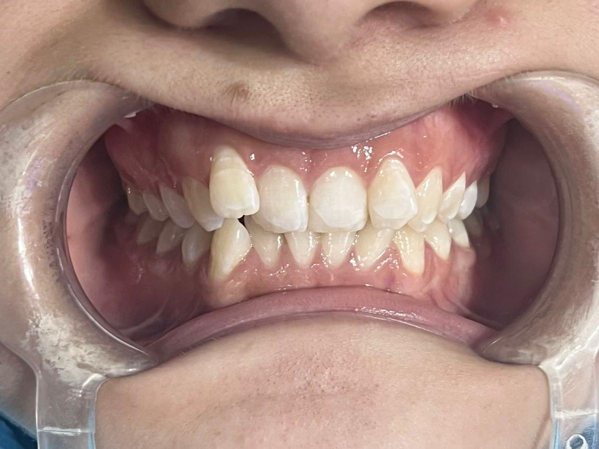 After fixed braces for crowding and an irregular bite at Ezza Dental Care