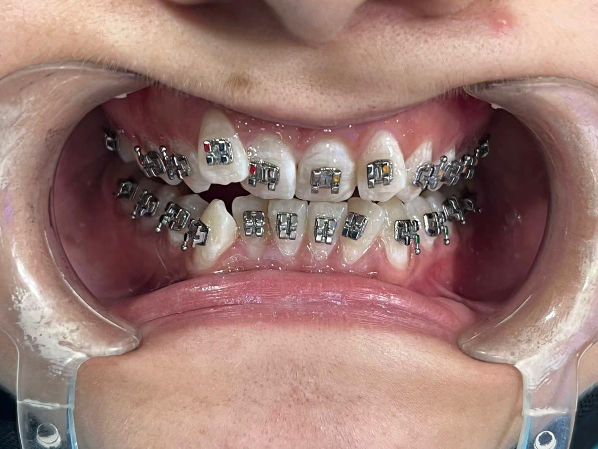 Before fixed braces for crowding and an irregular bite at Ezza Dental Care