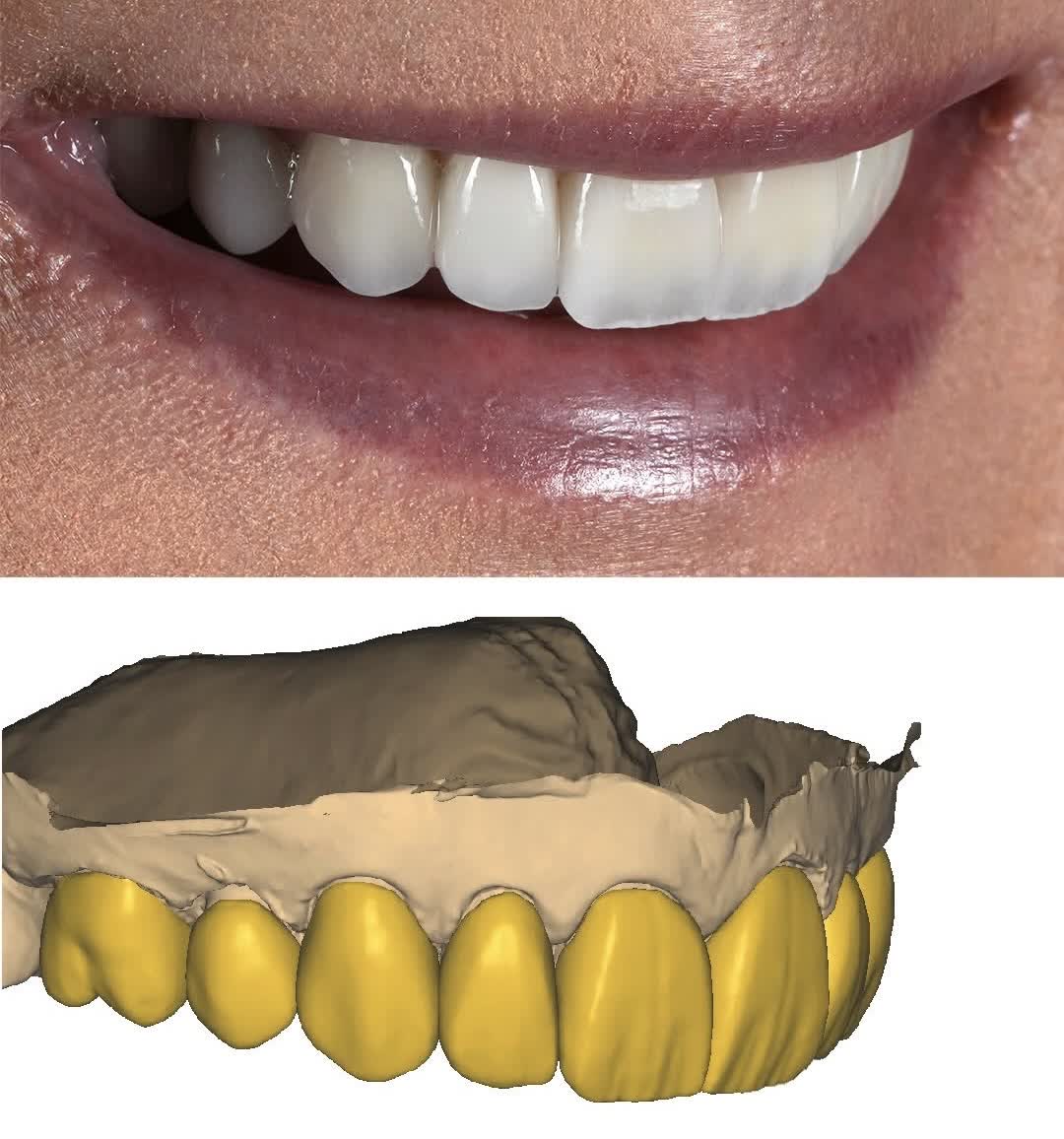 Smile photograph of finished upper restorations shown with the digital design record at Ezza Dental Care