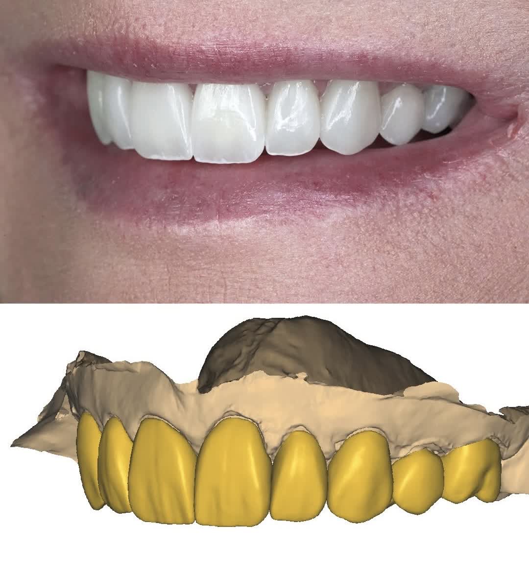 Side smile photograph paired with a digital dental model for treatment planning at Ezza Dental Care