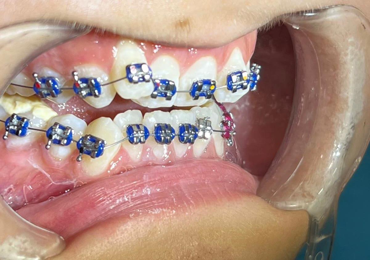Side view of the same braces case showing the archwire and an elastic in place at Ezza Dental Care