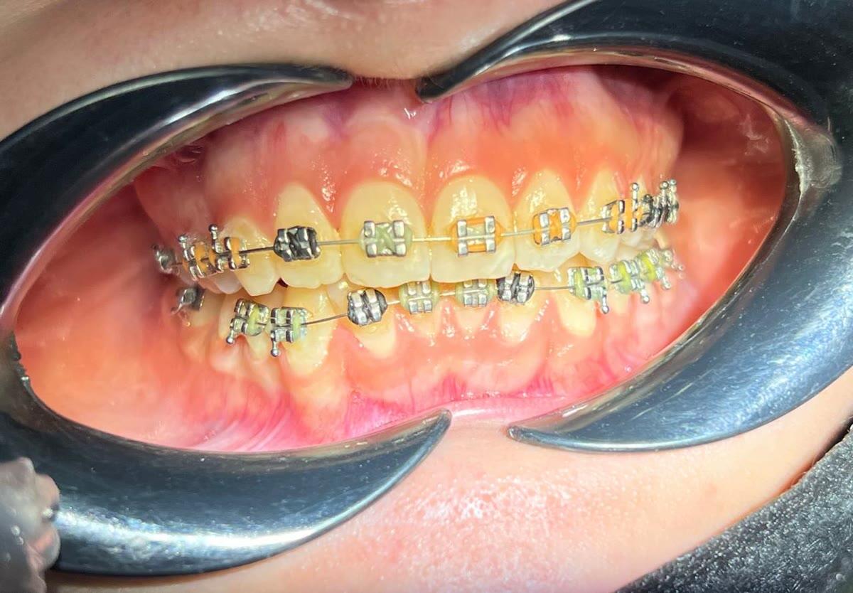 Close-up of orthodontic brackets with fresh elastic modules at a routine adjustment visit at Ezza Dental Care